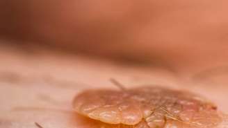 Dados recentes da Organização Mundial da Saúde (OMS) estimam que cerca de 80% das pessoas sexualmente ativas entrarão em contato com algum tipo de HPV ao longo da vida – depositphotos.com / gabitodorean