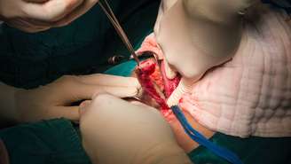 cirurgia de apendicite_depositphotos.com / chanawit