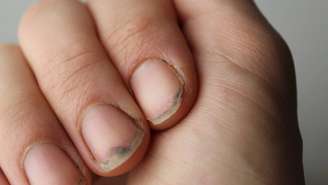 Unhas quebradiças – depositphotos.com / LyaNevada