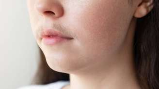 Nem todo excesso de pelos é igual: entender a diferença entre hirsutismo e hipertricose é essencial para um diagnóstico correto – depositphotos.com / Steklo_KRD