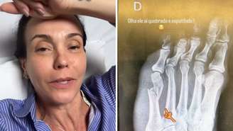 A atriz Flávia Monteiro quebrou o pé durante brincadeira em casa com filha e cachorro da família