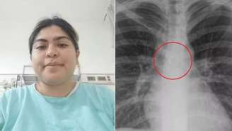 Monica Deyanira Cabrera Barajas descobriu que piercing no nariz que havia sumido estava alojado nos pulmões