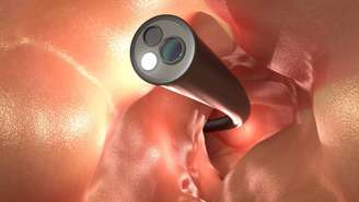 A colonoscopia é um exame visual. Nele, introduz-se um tubo flexível com câmera pelo reto, permitindo observar o revestimento interno do cólon e do reto. – depositphotos.com / phonlamai