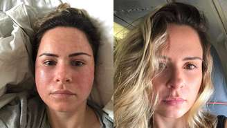 Entenda o procedimento de Laser de CO2 fracionado realizado por Ana Paula Renault