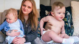 Macey-Mai é filha de Katelyn Clarke, de 23 anos, e nasceu com condição rara