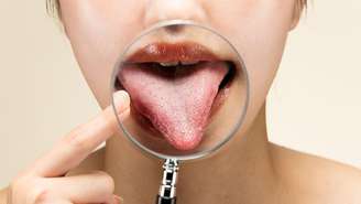 Veja o que pode significar a língua branca