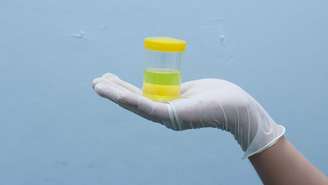 A urina com espuma pode estar associada tanto a problemas facilmente tratáveis quanto a condições mais graves, como a proteinúria