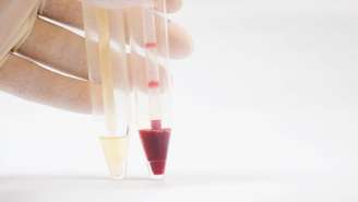 Essa mudança pode envolver pigmentos de alimentos, substâncias químicas de medicamentos ou, em situações mais delicadas, a presença de sangue, que tem o nome de hematúria – depositphotos.com / toeytoey