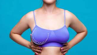 A ptose mamária costuma afetar a autoestima das mulheres