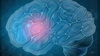 O AVC isquêmico ocorre quando o fluxo de sangue no cérebro é interrompido -depositphotos.com / blueringmedia