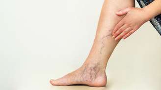 Entenda como a prisão de ventre pode contribuir para o surgimento de varizes; como alimentação, fibras e hidratação impactam a circulação