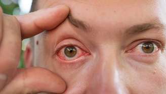 Especialistas apontam que mudanças na rotina de sono, uso de ar-condicionado e exposição prolongada a ambientes secos estão entre os fatores mais comuns. para o olho vermelho ao acordar – depositphotos.com / sfinks