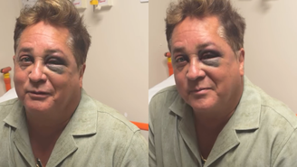 Leonardo aparece com olho roxo após acidente