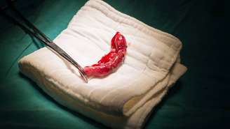 Apendicite: quando um órgão pequeno exige atenção médica rápida – depositphotos.com / chanawit