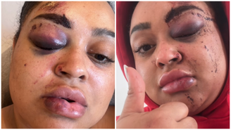 Ex-BBB Rízia Cerqueira detalha acidente com moto elétrica e exibe ferimentos