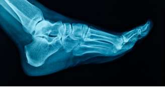 As intervenções cirúrgicas na região do pé são, em sua maioria, motivadas por traumas, desgastes e condições adquiridas, como o joanete e o pé plano