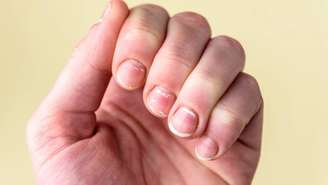Manchinhas brancas nas unhas? Na maioria das vezes, não é falta de cálcio -depositphotos.com / natali_ploskaya