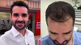Jornalista fez uma retrospectiva do procedimento realizado há dois anos