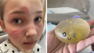 Menina sofre queimaduras após fazer trend do TikTok