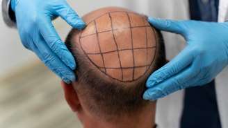 Transplante capilar