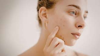 Pesquisa na Nature revela vacinas de RNA mensageiro para tratar a acne. Entenda como funciona a tecnologia e os alertas dos especialistas