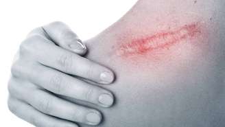 Quando ocorre um corte profundo, uma queimadura ou uma cirurgia, ocorre a substituição da pele original por um tecido de reparo, o tecido cicatricial – depositphotos.com / AY_PHOTO