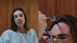 Nicole Bahls realiza transplante capilar 