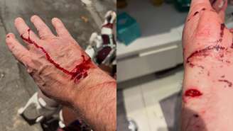 Ferimentos em âncora da Globo atacado por pitbull sem focinheira em SP