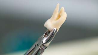 Dependendo do caso, o siso, dente que costuma aparecer entre os 17 e 25 anos, pode causar prejuízos como inflamações, dores e inchaço