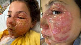 Violet Zerbst, de 10 anos, passou uma semana em um hospital de Gold Coast depois de aquecer um brinquedo mole em um microondas antes de apertá-lo