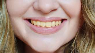 Dentes amarelados podem surgir por hábitos do dia a dia e até pelo envelhecimento; especialista explica como prevenir o problema