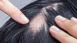 A queda de cabelo nem sempre é normal. Conheça os principais tipos de alopecia, suas causas e os tratamentos disponíveis