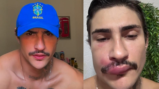 Influenciador Ken de CG é hospitalizado após espremer espinha