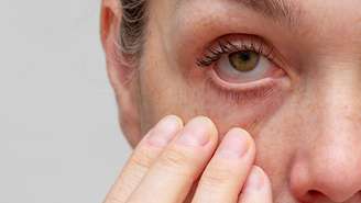 Segundo especialistas, o olho seco é uma queixa frequente durante a menopausa e pode ter origem hormonal