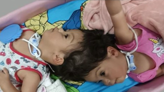 Morrem as gêmeas Helena e Heloísa, que nasceram unidas pela cabeça