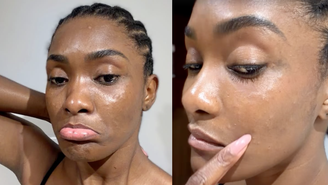Erika Januza revelou nas redes sociais que teve uma reação alérgica após comer peixe frito na gordura de camarão