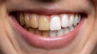 Consumo frequente de energéticos pode afetar a saúde dos dentes