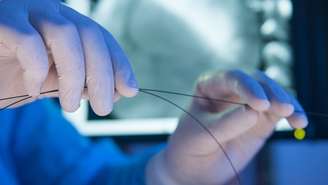 Combinação de litotripsia intravascular e balão farmacológico apresentou resultados promissores em artérias coronárias de pequeno calibre