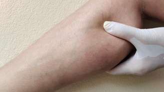 Lipedema pode causar dor, hematomas e desproporção corporal