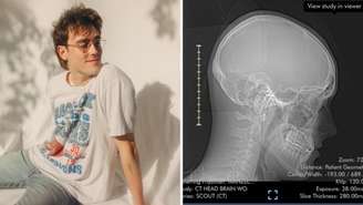Jake Luppen anunciou que fará cirurgia para retirar tumor cerebral e ficará acordado durante procedimento