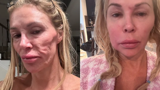 Brandi Glanville ficou com o rosto deformado por conta de suposto parasita