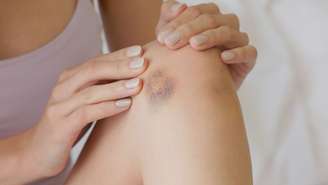 Parece contraintuitivo, mas o gelo em lesão, amplamente utilizado para aliviar a dor e reduzir a inflamação, está sendo reavaliado