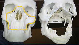 Imagem compara crânio normal com o do polonês após acidente