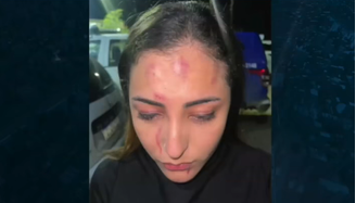 Soraya Oliveira mostra hematomas após sofrer agressão 