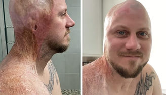 O norte-americano John Pendleton sofreu queimaduras de terceiro e quarto graus em 30% da parte superior do corpo; hoje ele ajuda pessoas a compartilharem suas histórias e lidarem com traumas