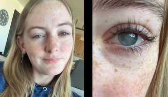 Jovem de 19 anos perde a visão após infecção rara ligada ao uso de lentes de contato
