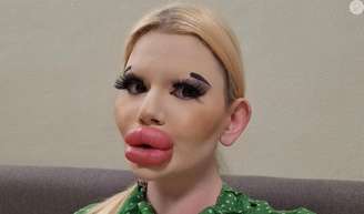 Mulher com os maiores lábios do mundo choca web e recebe alerta de médicos após 43 procedimentos estéticos.