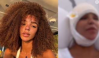 Antes e depois de Brunna Gonçalves: veja como esposa de Ludmilla ficou após diminuir a testa.