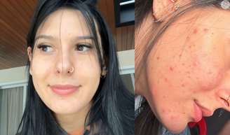 Ana Castela mostra antes e depois de tratamento para a acne e impressiona seguidores. Veja!.