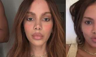 Exagerou? Após rosto 'irreconhecível' de Anitta viralizar, especialista alerta para riscos de procedimentos estéticos antes dos 35.